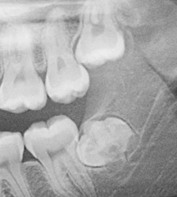 Wisdom Teeth and General Surgery