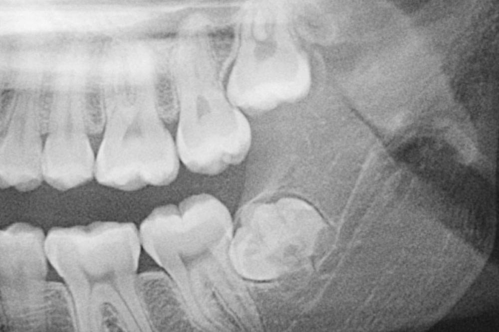 Wisdom-Teeth-Gen-Surgery