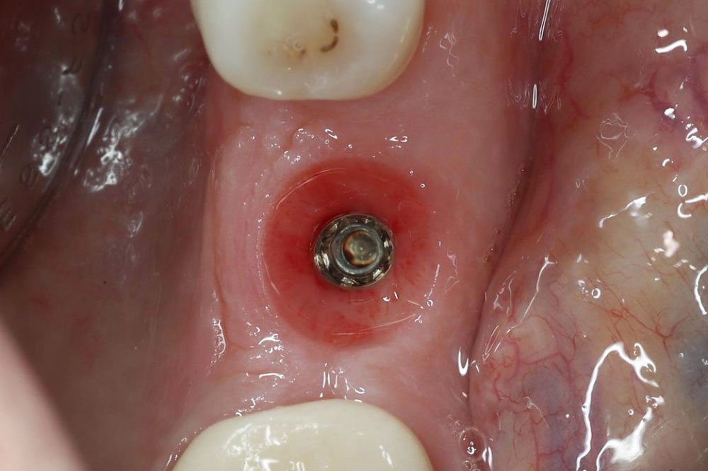 Course-Incorporate-Dental-Implants