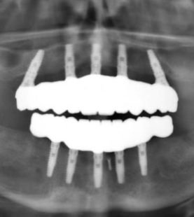 Implant Prosthetics: Full Arch Restoration