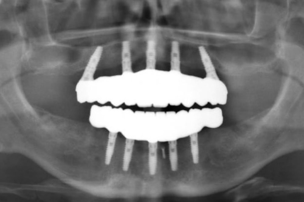 Course-implant-prostho-full-arch