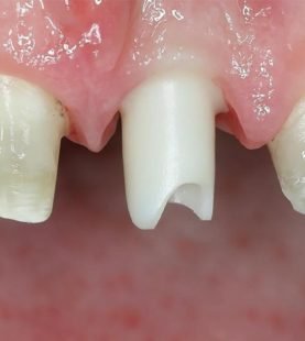 Anterior Implant Prosthetics