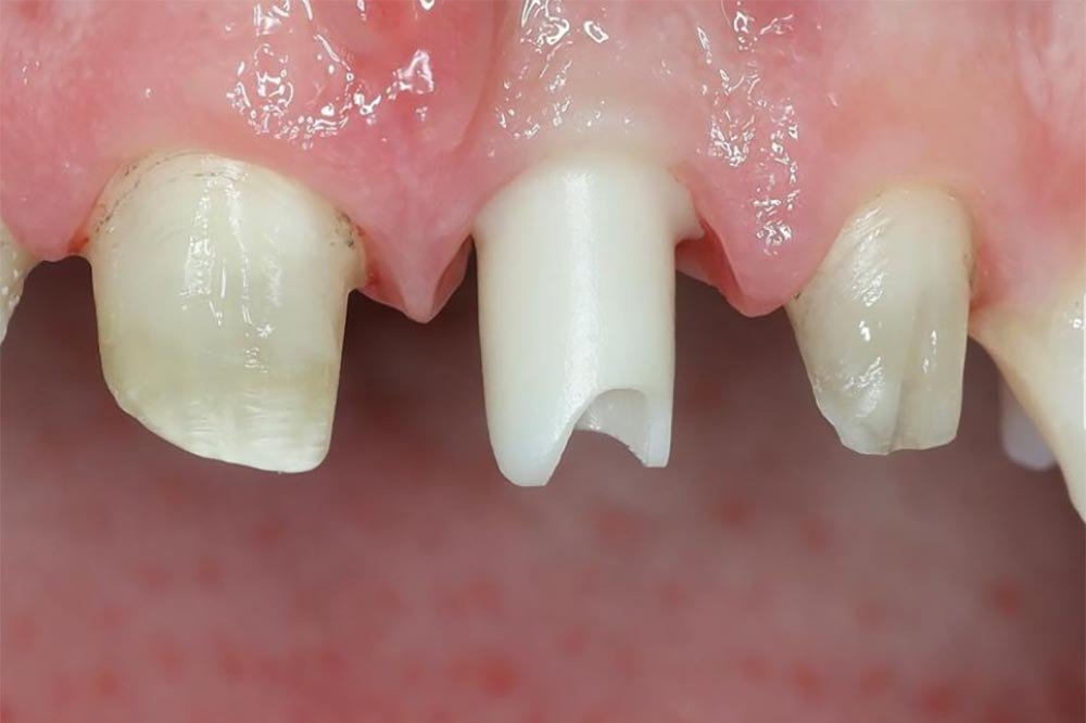Course-Implant-Prostho-Anterior(1)