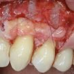 Periodontal Grafting and Crown Lengthening Surgery
