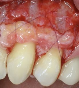 Periodontal Grafting and Crown Lengthening Surgery