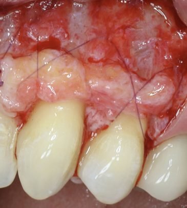 Periodontal Grafting and Crown Lengthening Surgery