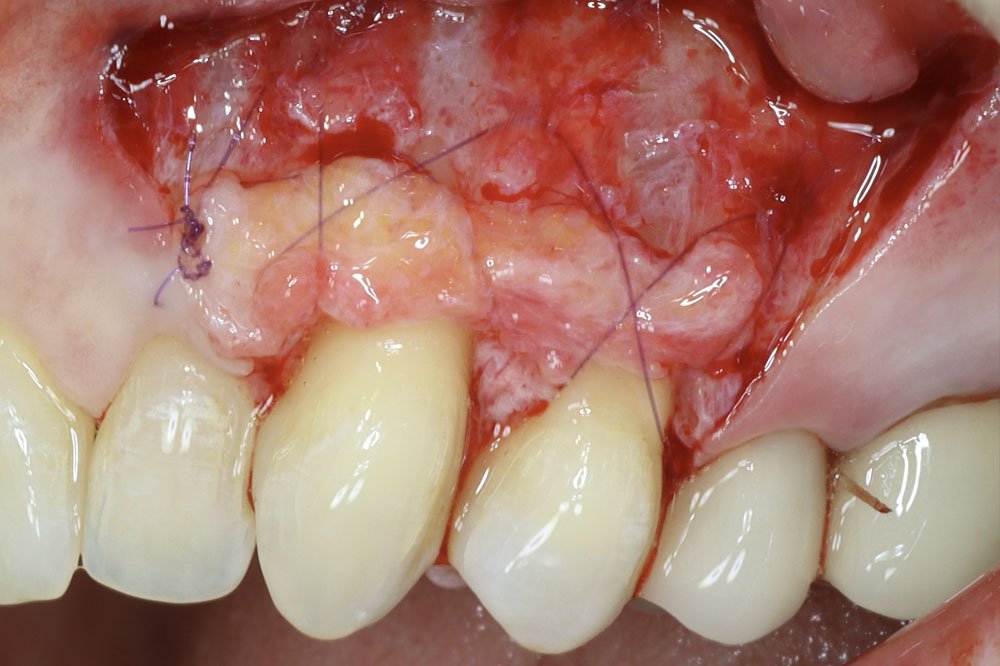 Course-Periodontal-Grafting(1)