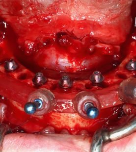 Advanced Implant Residency