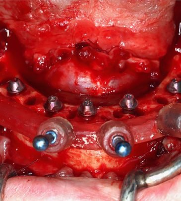 Advanced Implant Residency